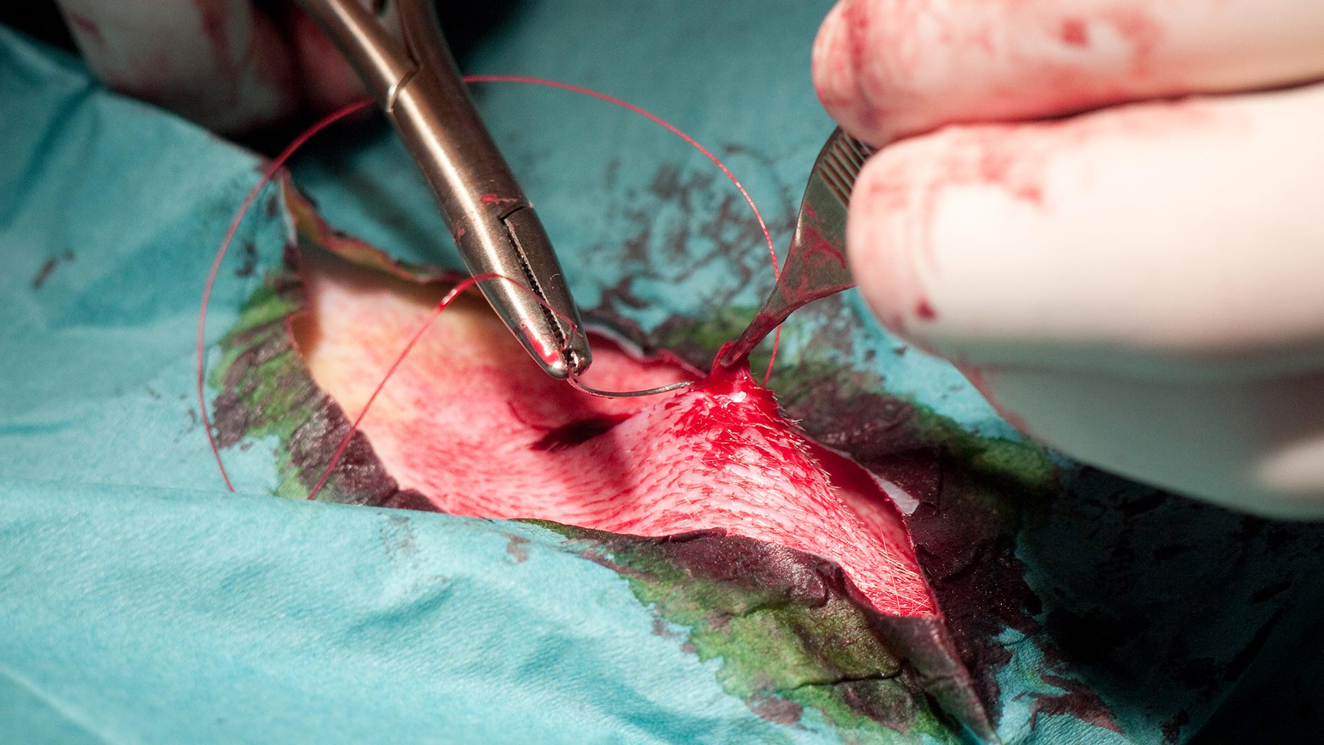 Advanced Laparoscopic Colorectal Surgery Using
